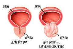 確診前列腺增生前需要做哪些檢查