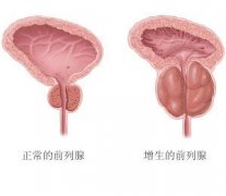 前列腺增生會影響性生活質(zhì)量嗎