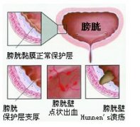 怎么治療膀胱炎效果最好