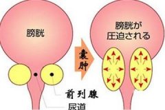 治療男性前列腺囊腫需要多少錢