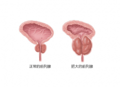 前列腺肥大的原因